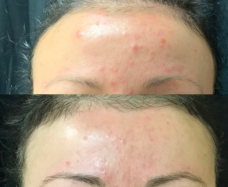 my miracle cream before and after treatment